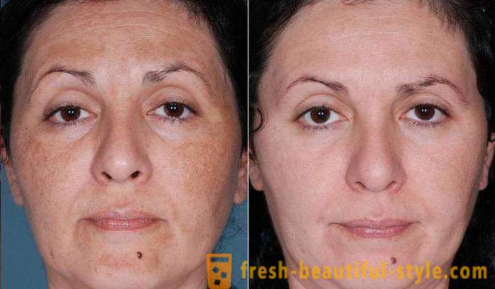 Säure Peelings für das Gesicht: Bewertungen, Fotos vor und nach