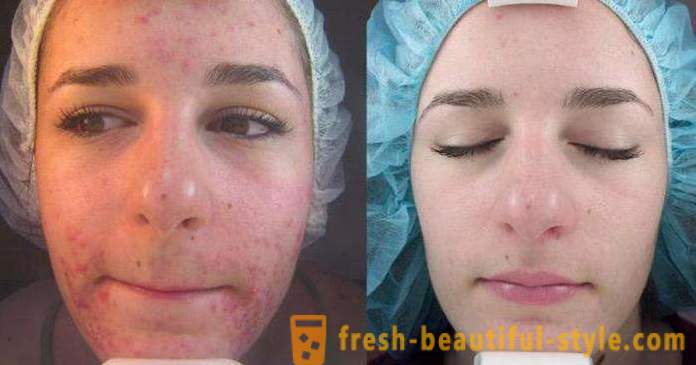 Säure Peelings für das Gesicht: Bewertungen, Fotos vor und nach