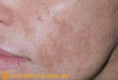 Braune Flecken auf dem Gesicht: die Ursachen und Behandlungen. braune Flecken
