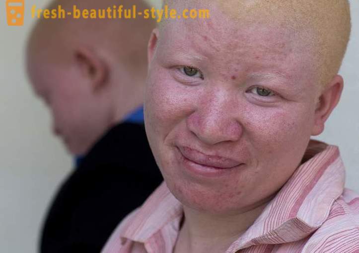 Die tragische Geschichte der tansanischen Albinos