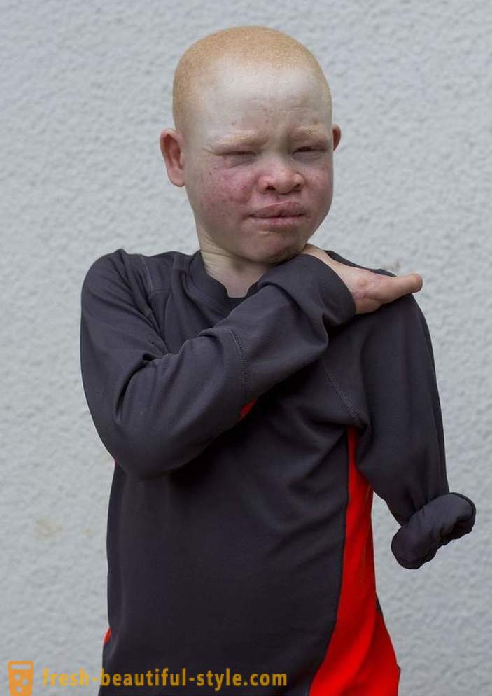 Die tragische Geschichte der tansanischen Albinos