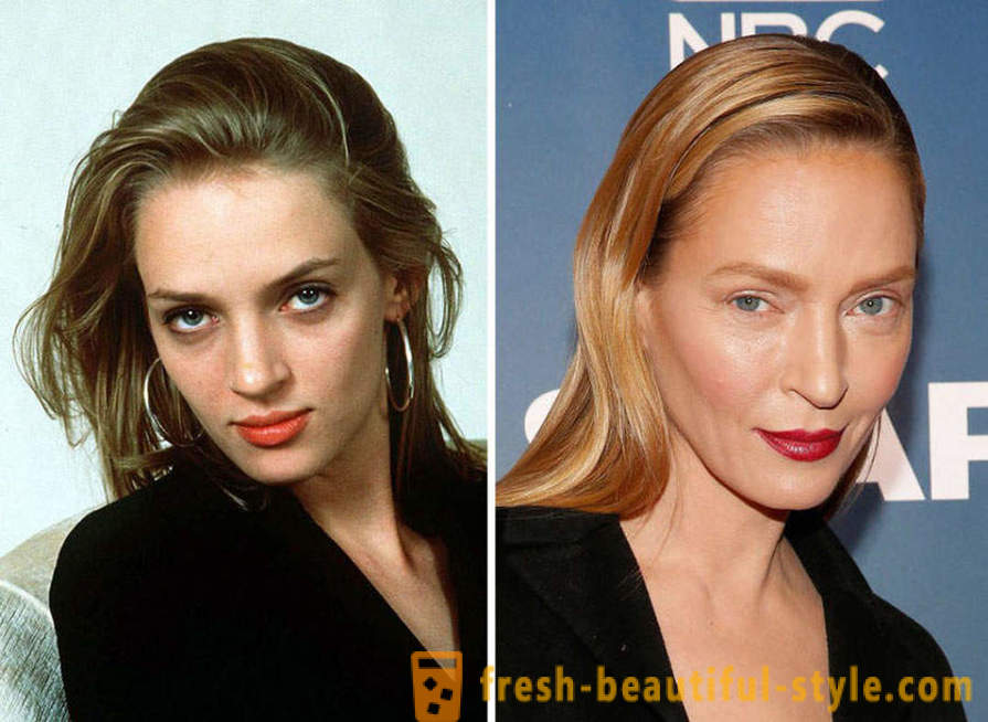 15 Prominente, fertig schlecht mit Botox