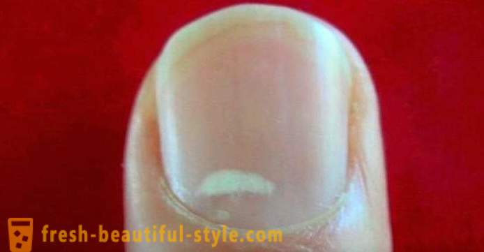 Weiße Flecken auf den Nägeln der Finger: die Ursachen und Behandlung
