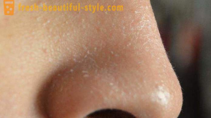 Warum schuppige Haut auf dem Gesicht? Problem Gesichtshaut