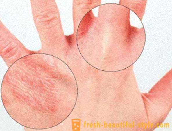 Trockene Haut der Hände: Ursachen. Sehr trockene Haut, was zu tun ist?