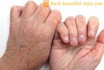 Trockene Haut der Hände: Ursachen. Sehr trockene Haut, was zu tun ist?