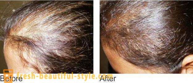 Mesotherapie für die Haare: Make-up-Tools und Kontra