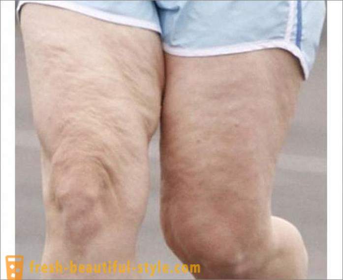 Wie wird man auf die Beine von Cellulite loswerden? Übungen für die Beine der Cellulite