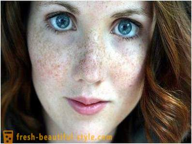 Kümmern sich um ihre Schönheit und Jugend: Ursachen Pigmentierung im Gesicht